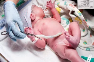 Double Trouble What to Do When an Ultrasound Reveals a Double Nuchal Cord