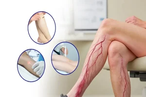 Varicose Veins