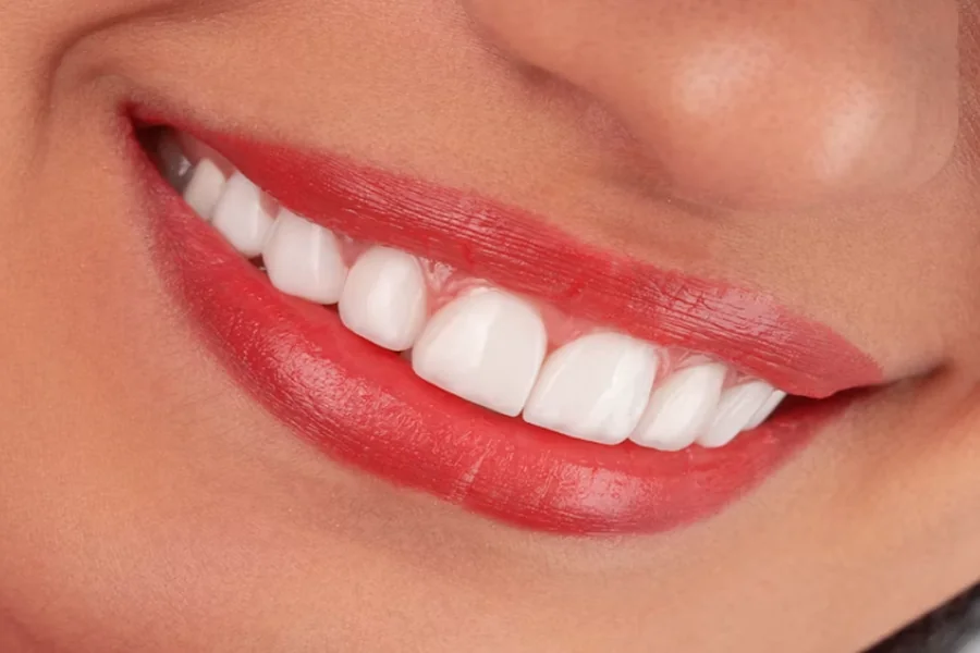 Why Top Dental Clinics Choose Premium Teeth Whitening Supplies and Consumables